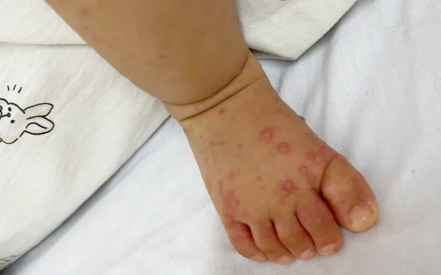 Trẻ mắc tay chân miệng. Ảnh: BVCC
