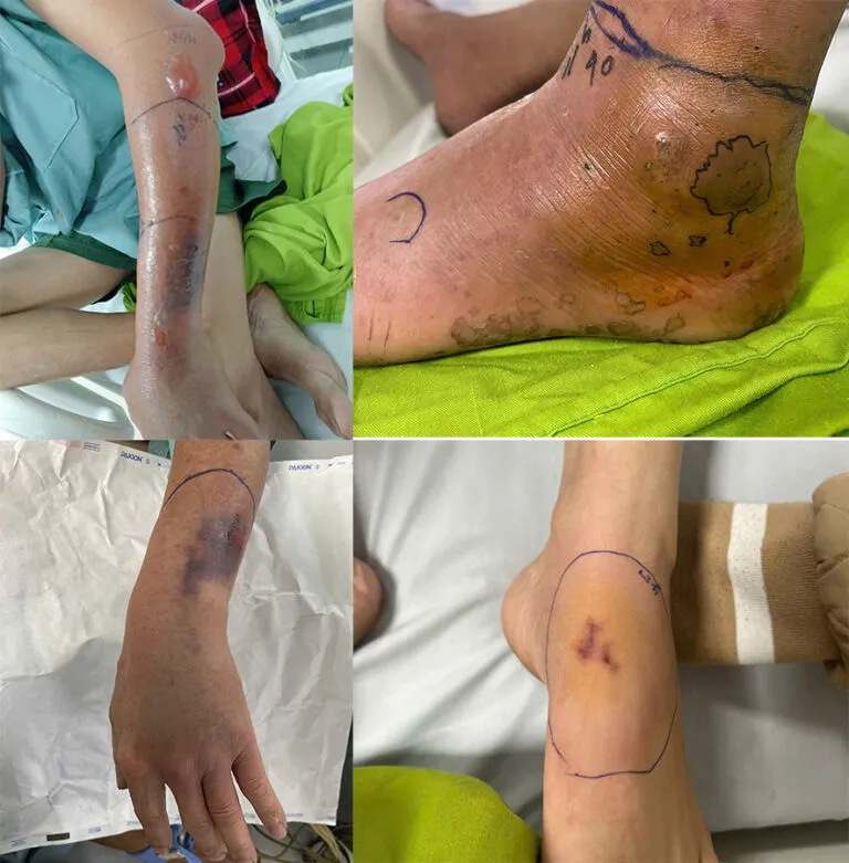 Cảnh b&aacute;o nguy cơ rắn độc cắn tăng cao m&ugrave;a rắn sinh sản- Ảnh 1.