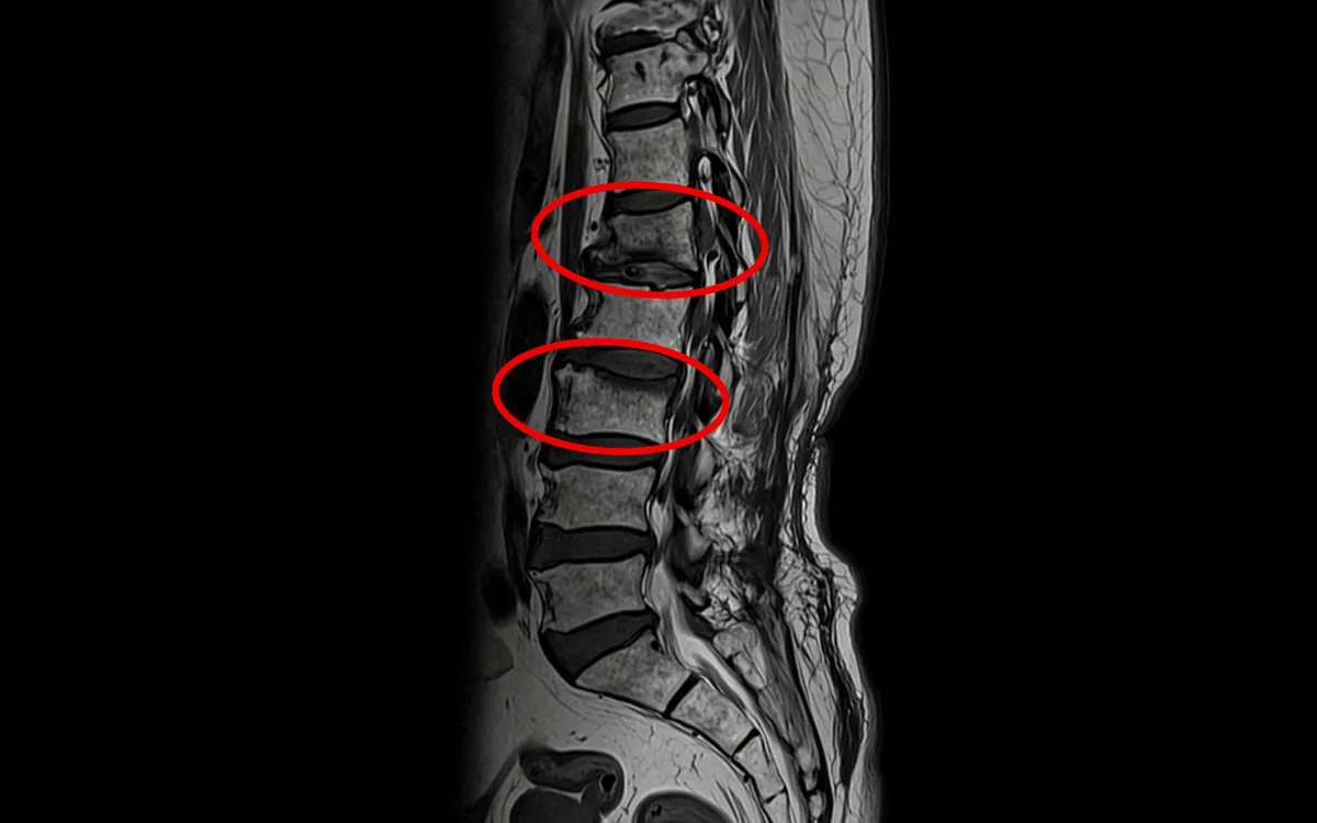 Xẹp 2 đốt sống v&igrave; uống thuốc đ&ocirc;ng y giảm đau xương khớp- Ảnh 2.
