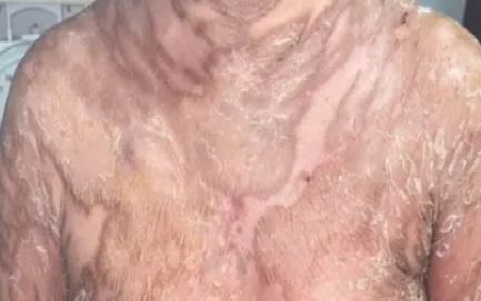 Tổn thương của bệnh nhân ở lần nhập viện đầu tiên: tổn thương cơ bản là dát đỏ bong vảy ranh giới rõ, tập trung thành mảng phân bố khắp tay chân thân mình. Ảnh: BVCC