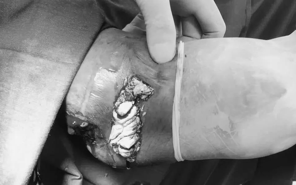 Mụn tophi chảy dịch của bệnh nhân mắc gout. Ảnh: BVCC