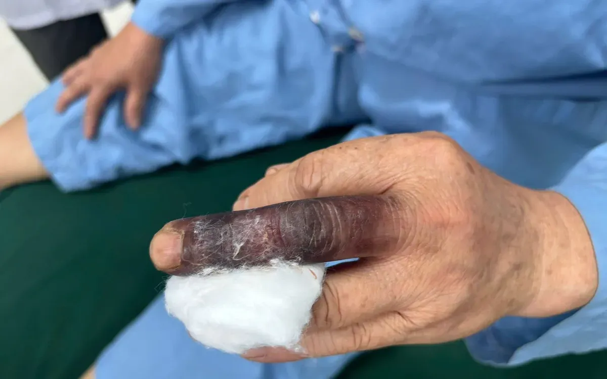 Ch&iacute;n m&eacute; ng&oacute;n tay: Kh&ocirc;ng tự &yacute; đắp thuốc l&aacute;- Ảnh 1.