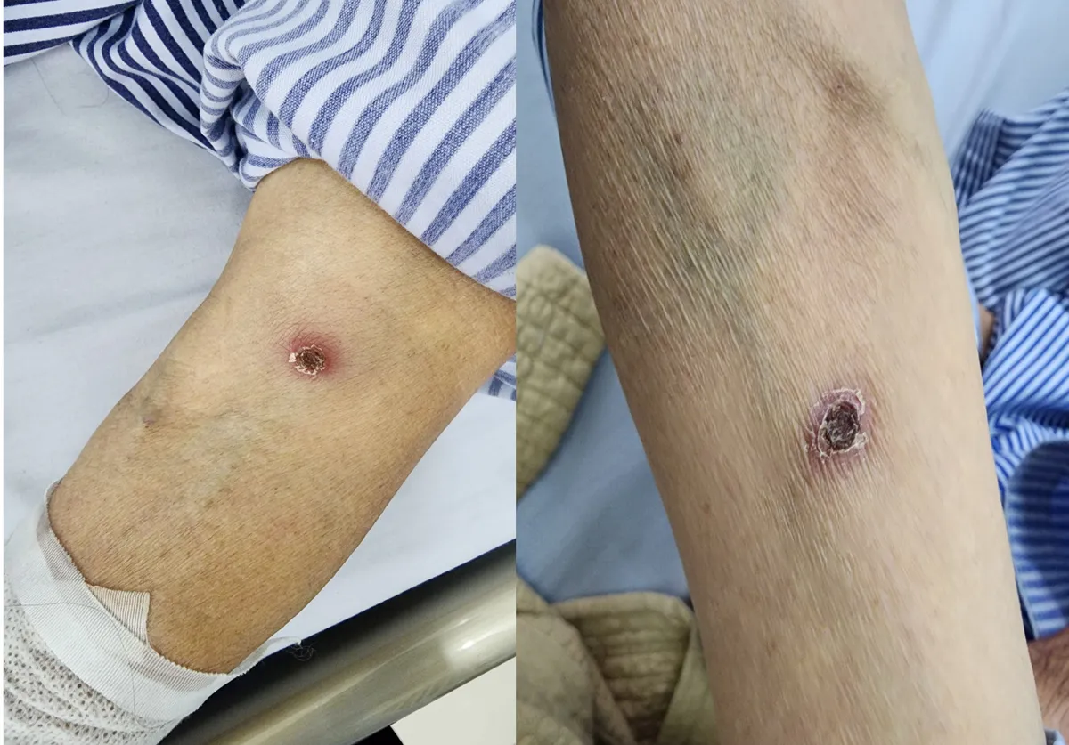 Cảnh gi&aacute;c với sốt m&ograve;: Bệnh dễ nhầm cảm c&uacute;m nhưng c&oacute; thể g&acirc;y biến chứng nguy hiểm- Ảnh 1.