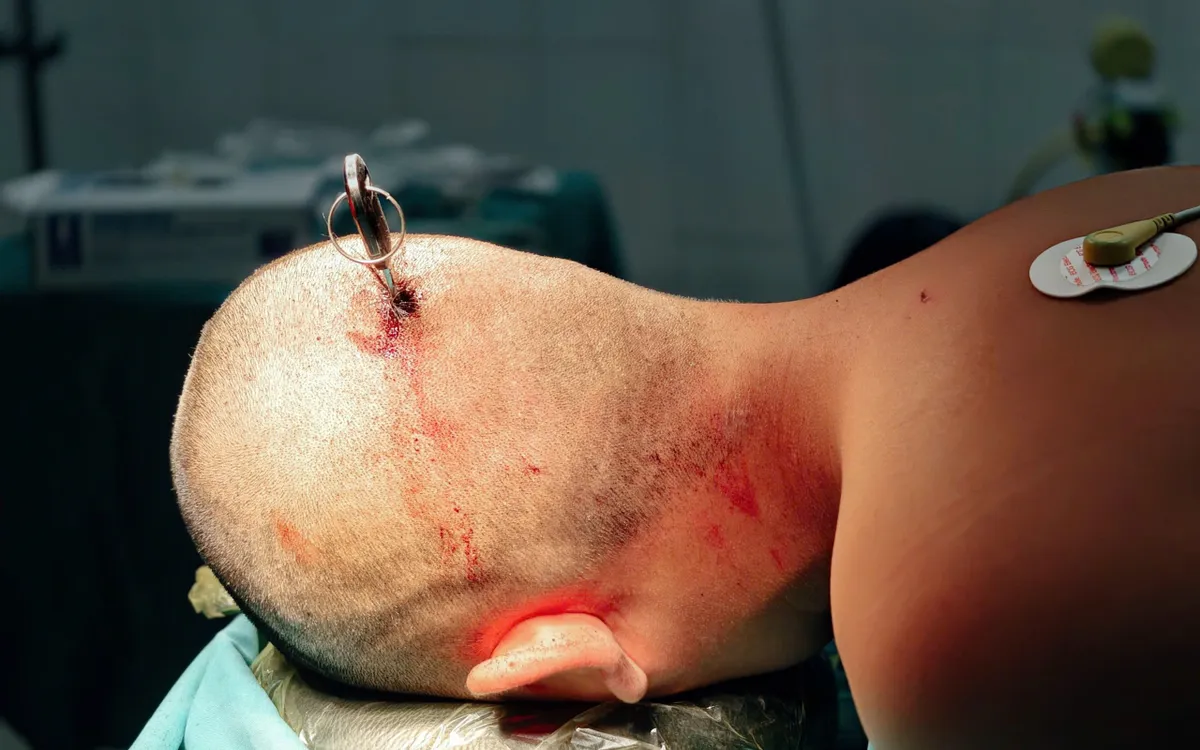 Bệnh nhân nhập viện trong tình trạng có vết thương vùng đỉnh chẩm, kèm theo dị vật là một chiếc chìa khóa cắm sâu tại vị trí tổn thương. Ảnh: BVCC