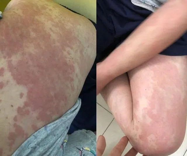 Cảnh báo bệnh da liễu gia tăng sau khi đi bơi giải nhiệt mùa nắng nóng- Ảnh 1. Cảnh báo bệnh da liễu gia tăng sau khi đi bơi giải nhiệt mùa nắng nóng- Ảnh 1.