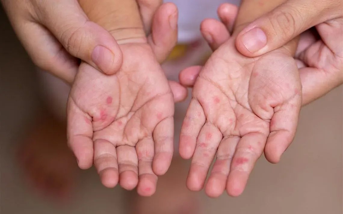 Bùng phát bệnh tay chân miệng đầu mùa hè: Cảnh báo biến chứng nặng do chủ quan trong điều trị- Ảnh 1. Bùng phát bệnh tay chân miệng đầu mùa hè: Cảnh báo biến chứng nặng do chủ quan trong điều trị- Ảnh 1.