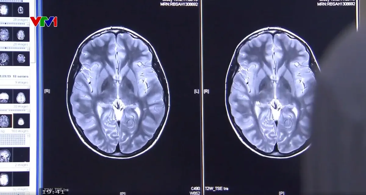 Mỹ phát triển phương pháp xét nghiệm máu giúp phát hiện sớm bệnh Alzheimer- Ảnh 1. Mỹ phát triển phương pháp xét nghiệm máu giúp phát hiện sớm bệnh Alzheimer- Ảnh 1.