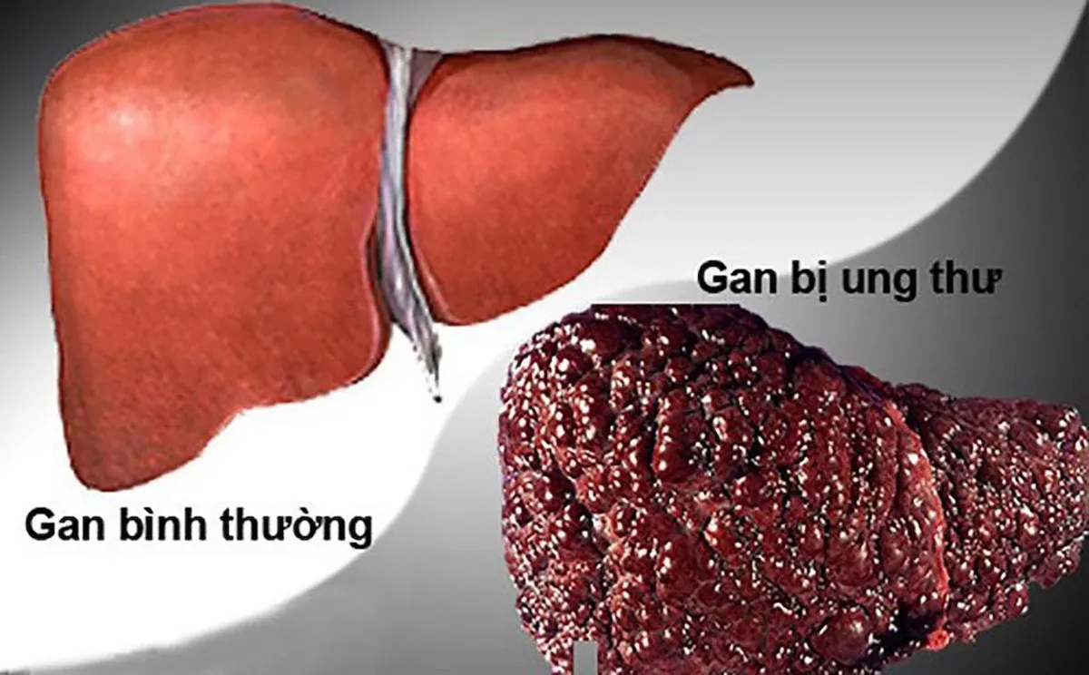 Ung thư gan &acirc;m thầm nhưng nguy hiểm: Người thuộc nh&oacute;m nguy cơ cao cần l&agrave;m g&igrave; để ph&ograve;ng bệnh?- Ảnh 1.