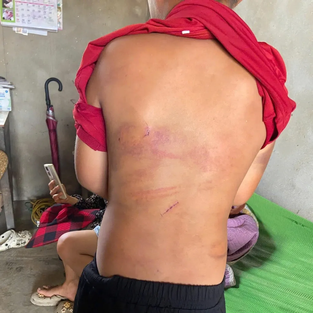 Vụ b&eacute; trai 10 tuổi nhiều vết bầm t&iacute;m tr&ecirc;n cơ thể: C&ocirc;ng an khẩn trương x&aacute;c minh phản &aacute;nh nghi bạo h&agrave;nh- Ảnh 1.