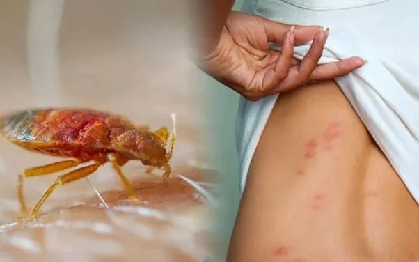 Mùa hè nhiều côn trùng độc, cảnh giác nguy cơ sốc phản vệ đe dọa tính mạng- Ảnh 1. Mùa hè nhiều côn trùng độc, cảnh giác nguy cơ sốc phản vệ đe dọa tính mạng- Ảnh 1.