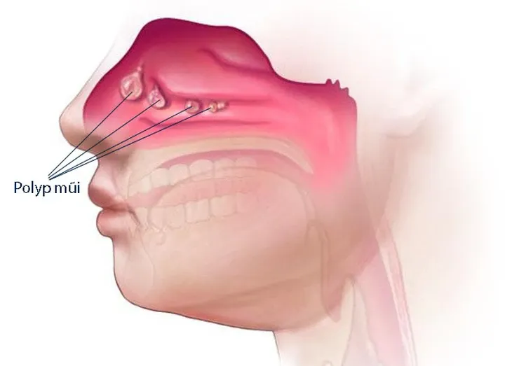 Polyp mũi có nguy hiểm không? Những điều nhiều người thường bỏ qua- Ảnh 1. Polyp mũi có nguy hiểm không? Những điều nhiều người thường bỏ qua- Ảnh 1.