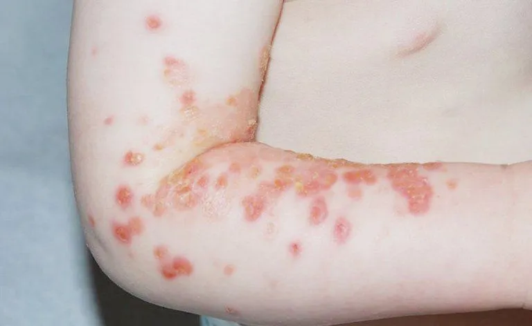 Cảnh b&aacute;o bệnh chốc lở ở trẻ em: Dễ l&acirc;y lan nhưng c&oacute; thể ph&ograve;ng ngừa nếu ph&aacute;t hiện sớm- Ảnh 1.
