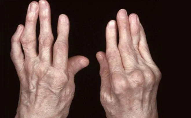 Đừng xem nhẹ vi&ecirc;m khớp: Những biến chứng nguy hiểm c&oacute; thể dẫn đến t&agrave;n phế- Ảnh 1.