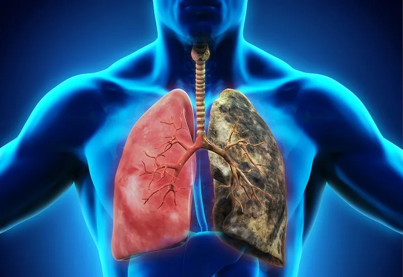 Kh&ocirc;ng h&uacute;t thuốc nhưng vẫn c&oacute; nguy cơ mắc ung thư phổi: Những nguy&ecirc;n nh&acirc;n &iacute;t người ngờ tới- Ảnh 1.