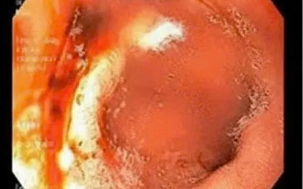 Bệnh nhân bị loét tá tràng do sử dụng thuốc cũ.