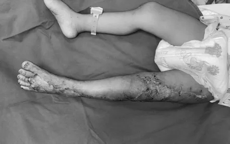 Vùng chân được tái tạo. Ảnh: Bệnh viện Bạch Mai