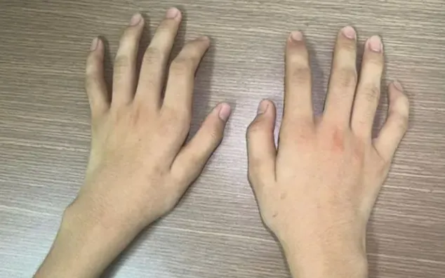 Tình trạng teo cơ hai bên bên trái rõ hơn bên phải. Ảnh: Bệnh viện Trung ương Quân đội 108