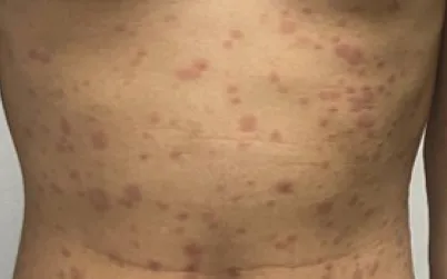 Ảnh: Bệnh viện Da liễu Trung ương