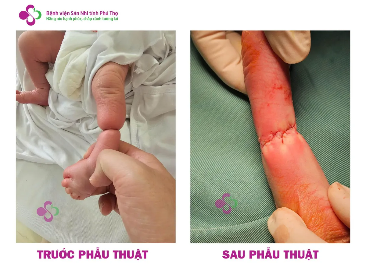 Phẫu thuật thành công cho trẻ sơ sinh bị vòng xơ thắt nghẹt chi- Ảnh 1.