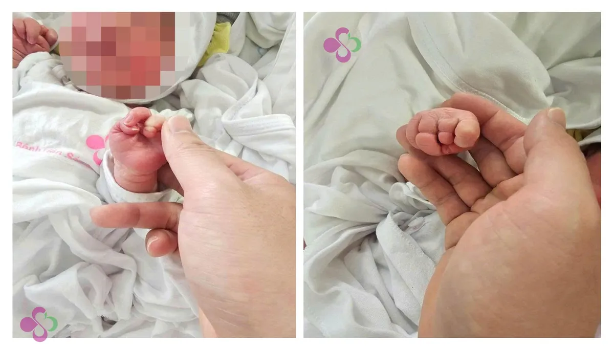 Phẫu thuật thành công cho trẻ sơ sinh bị vòng xơ thắt nghẹt chi- Ảnh 2.