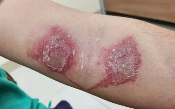 Ảnh: Bệnh viện Da liễu Quảng Nam