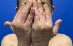 Ảnh: Bệnh viện Da liễu Trung ương