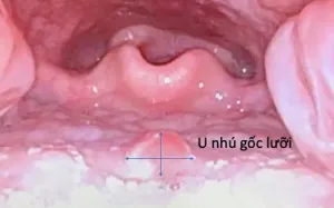 Lạc sản niêm mạc dạ dày - bệnh cảnh hiếm gặp