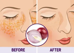 Bí quyết đánh bay thâm nám tự nhiên
