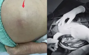 Cảnh báo nguy cơ biến chứng nghiêm trọng do tự ý tiêm thuốc