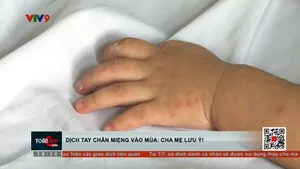 Dịch chân tay miệng vào mùa: Cha mẹ lưu ý