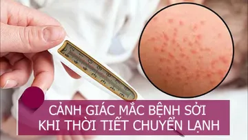 Cảnh giác mắc bệnh sởi khi thời tiết chuyển lạnh