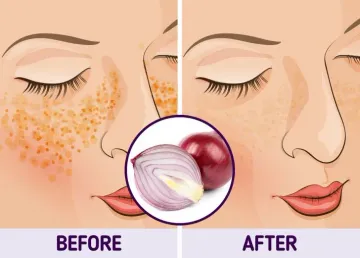 Bí quyết đánh bay thâm nám tự nhiên