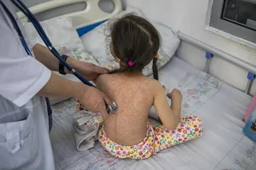 Dịch sởi nghiêm trọng nhất trong nhiều năm tại Mỹ