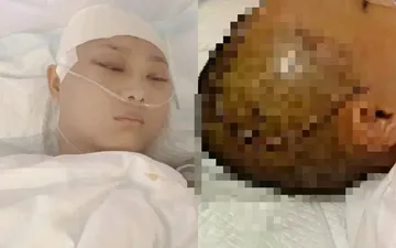 Diễn viên đóng thế Trung Quốc bị chấn thương sọ não, dư luận phẫn nộ trước sự thờ ơ của đoàn phim