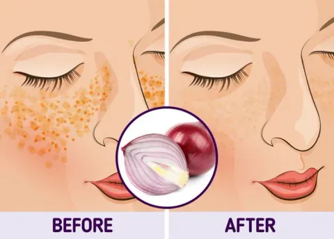 Bí quyết đánh bay thâm nám tự nhiên