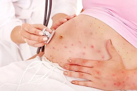 Mẹ bầu mắc sởi - Có ảnh hưởng em bé?