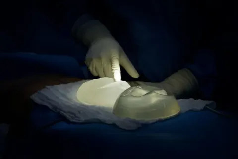 Những điều cần biết trước khi tháo túi ngực và đặt lại túi mới
