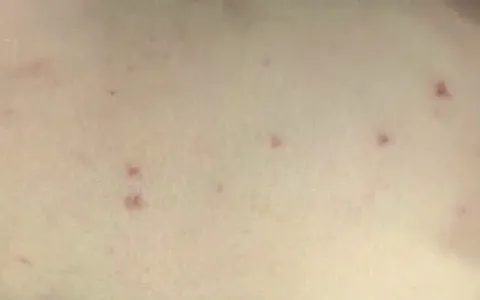Yên Bái: Một trường hợp dương tính với vi khuẩn não mô cầu