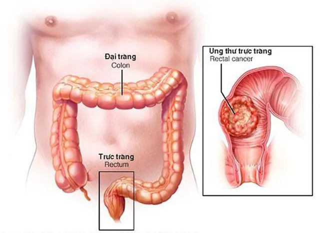 Ung thư đại tràng tấn công 4 triệu người Việt - Ảnh 2.