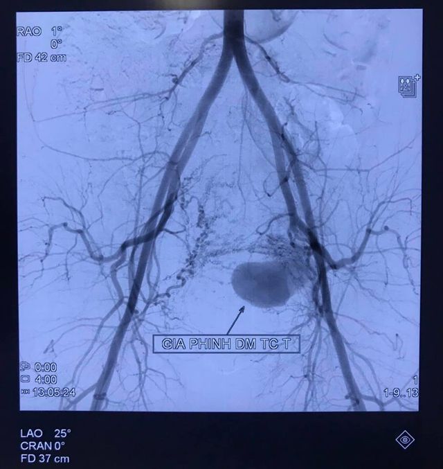 Cứu sống sản phụ bị chảy máu ồ ạt sau đẻ bằng phương pháp can thiệp nội mạch - Ảnh 1.