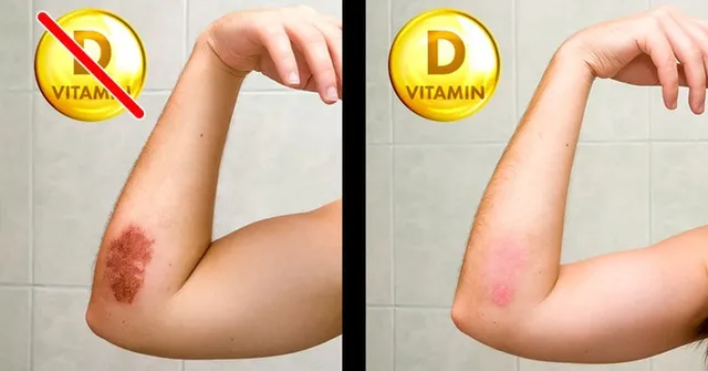 8 dấu hiệu chứng tỏ bạn cần bổ sung vitamin D - Ảnh 6.