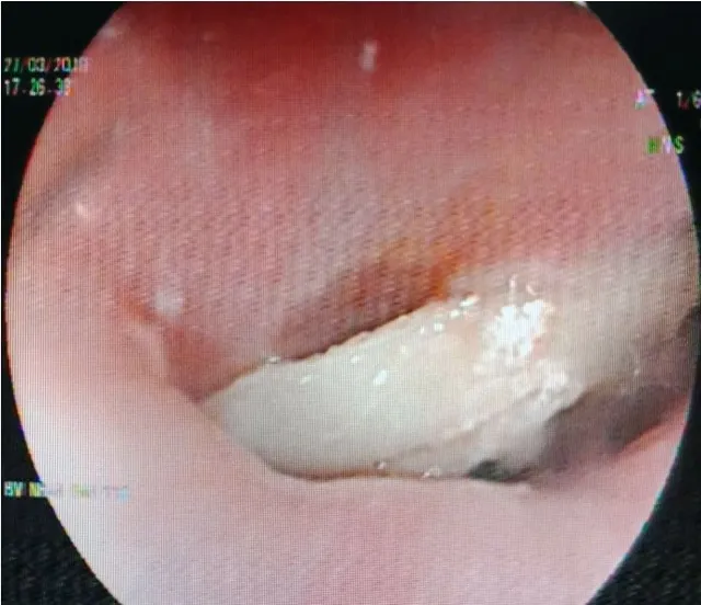 Uống nước, nuốt luôn răng giả - Ảnh 2.