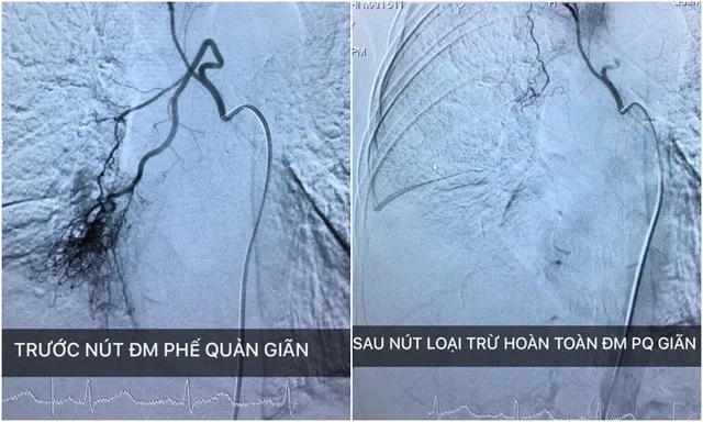 Nút mạch phế quản thành công cho bệnh nhân ho ra máu 3 tuần - Ảnh 1.