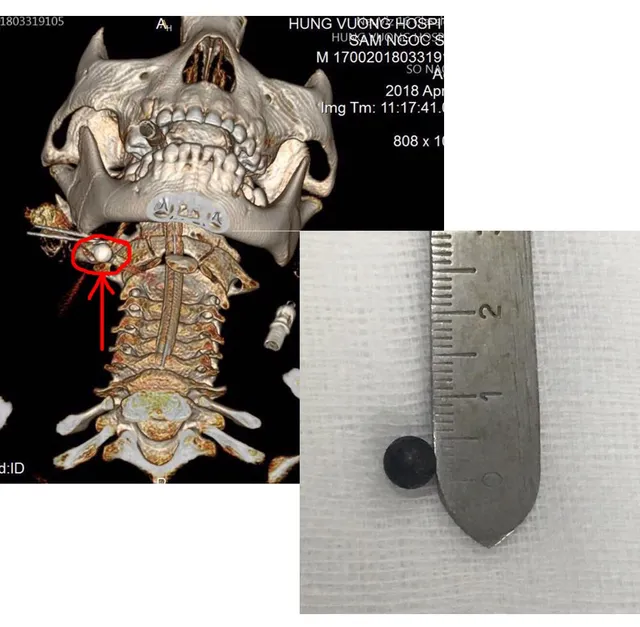 Bi sắt găm vào xương hàm do nghịch đồ chơi tự chế - Ảnh 2.