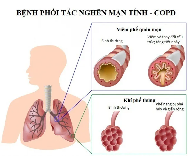 Hen suyễn, phổi tắc nghẽn mãn tính và những điều cần biết - Ảnh 2.