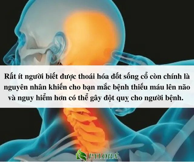 Nguy cơ bại liệt từ bệnh lý thoái hóa đốt sống cổ - Ảnh 2.