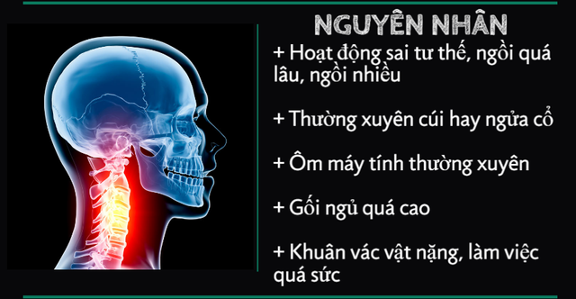 Nguy cơ bại liệt từ bệnh lý thoái hóa đốt sống cổ - Ảnh 1.