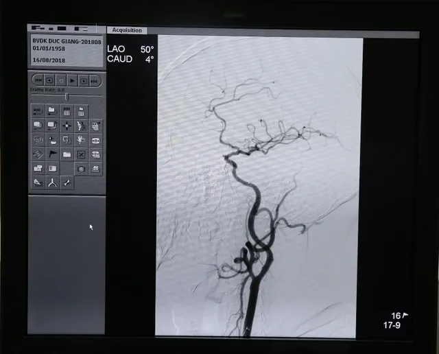 Can thiệp thành công cứu bệnh nhân hẹp động mạch cảnh - Ảnh 1.
