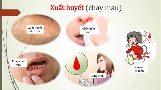 Chủ quan khi mắc bệnh sốt xuất huyết có thể dẫn tới suy đa tạng - Ảnh 1.