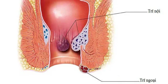 8 nguyên nhân gây đau hậu môn - Ảnh 1.